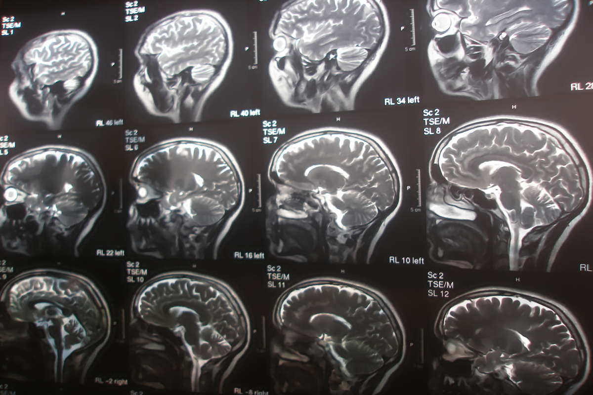 Photos d’un scanner cérébal.